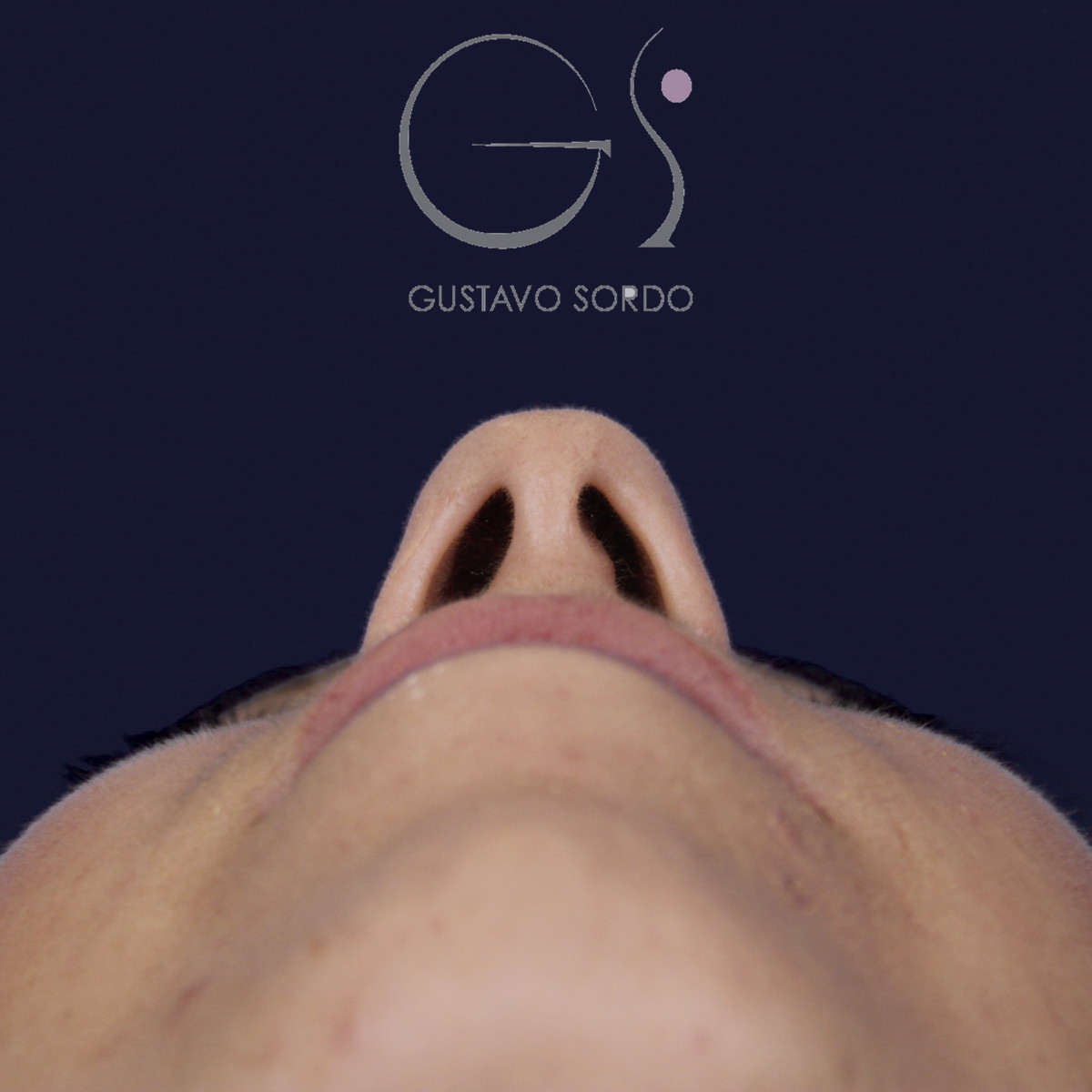 Rinoplastia ultrasónica y mentoplastia en nariz desviada, vista basal, antes de la cirugía — caso del Dr. Gustavo Sordo en Madrid