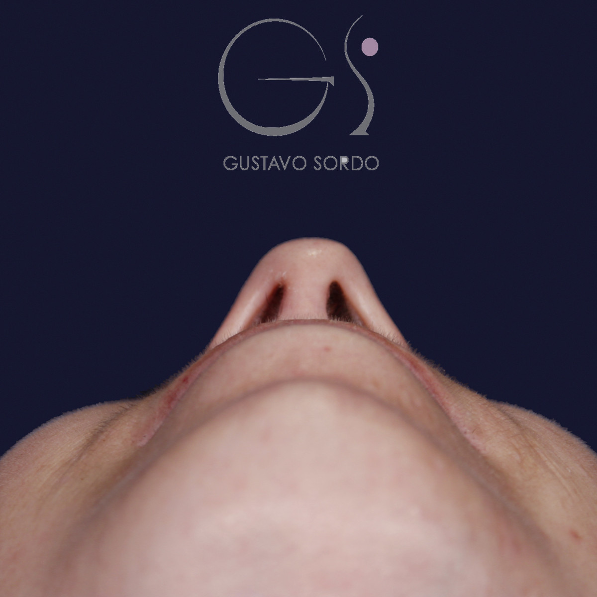 Rinoplastia ultrasónica y mentoplastia en nariz desviada, vista basal, al año de la mentoplastia — caso del Dr. Gustavo Sordo en Madrid
