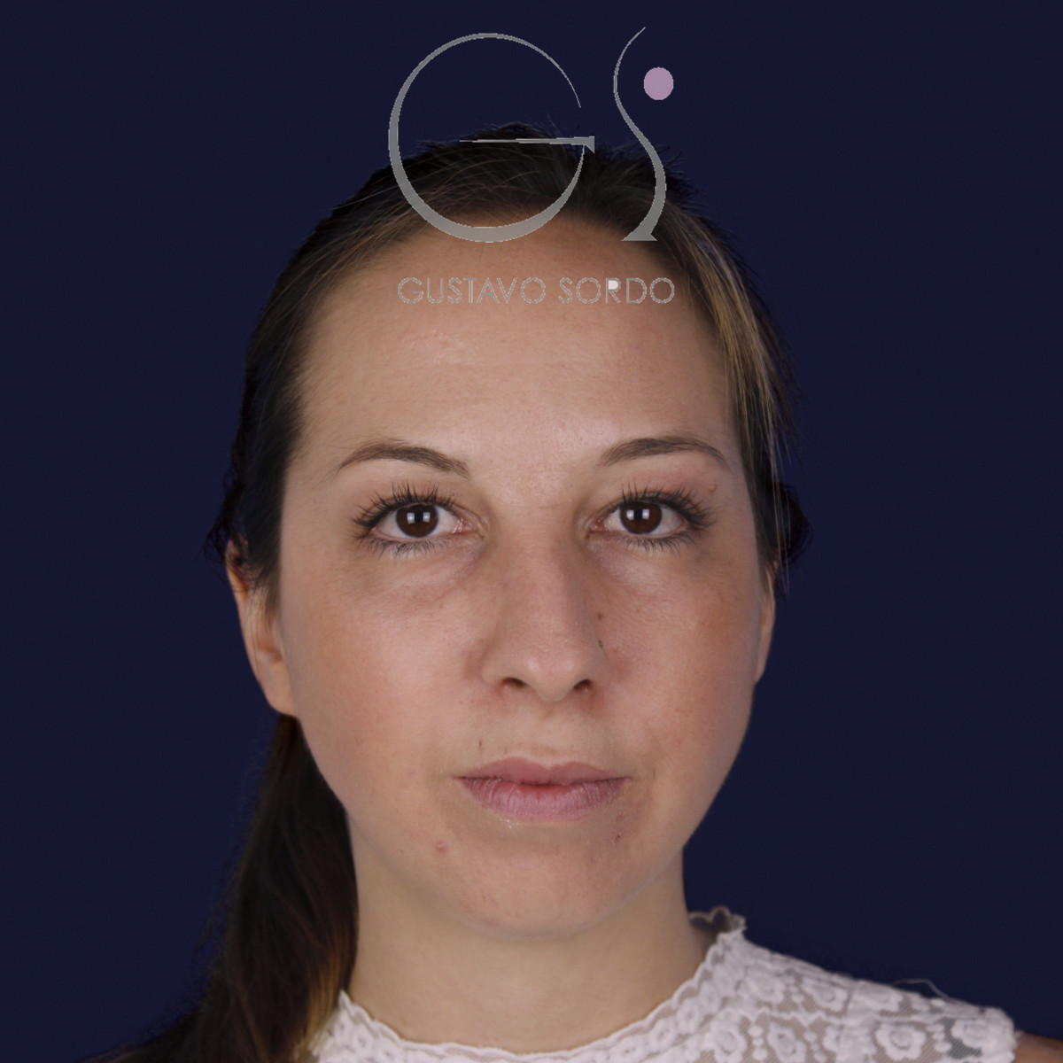 Rinoplastia ultrasónica y mentoplastia en nariz desviada, de frente, antes de la cirugía — caso del Dr. Gustavo Sordo en Madrid