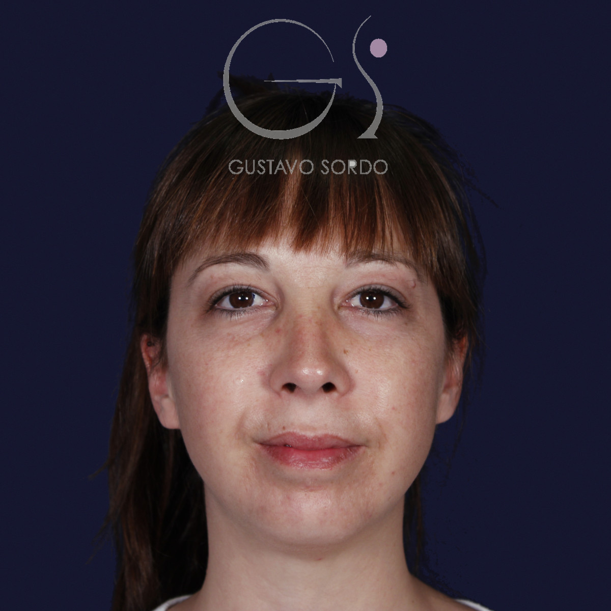 Rinoplastia ultrasónica y mentoplastia en nariz desviada, de frente, al año de la mentoplastia — caso del Dr. Gustavo Sordo en Madrid