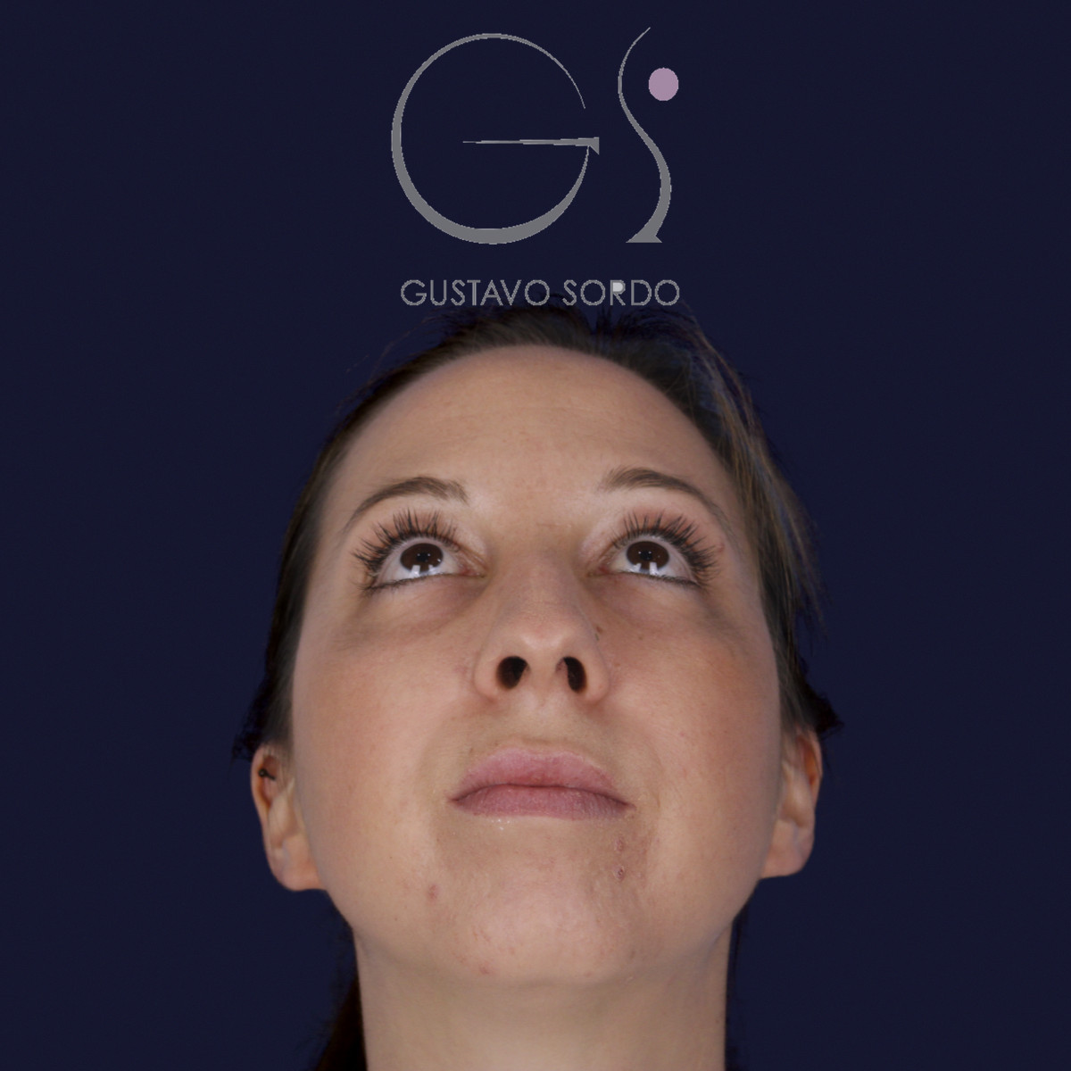 Rinoplastia ultrasónica y mentoplastia en nariz desviada, con el mentón elevado, antes de la cirugía — caso del Dr. Gustavo Sordo en Madrid