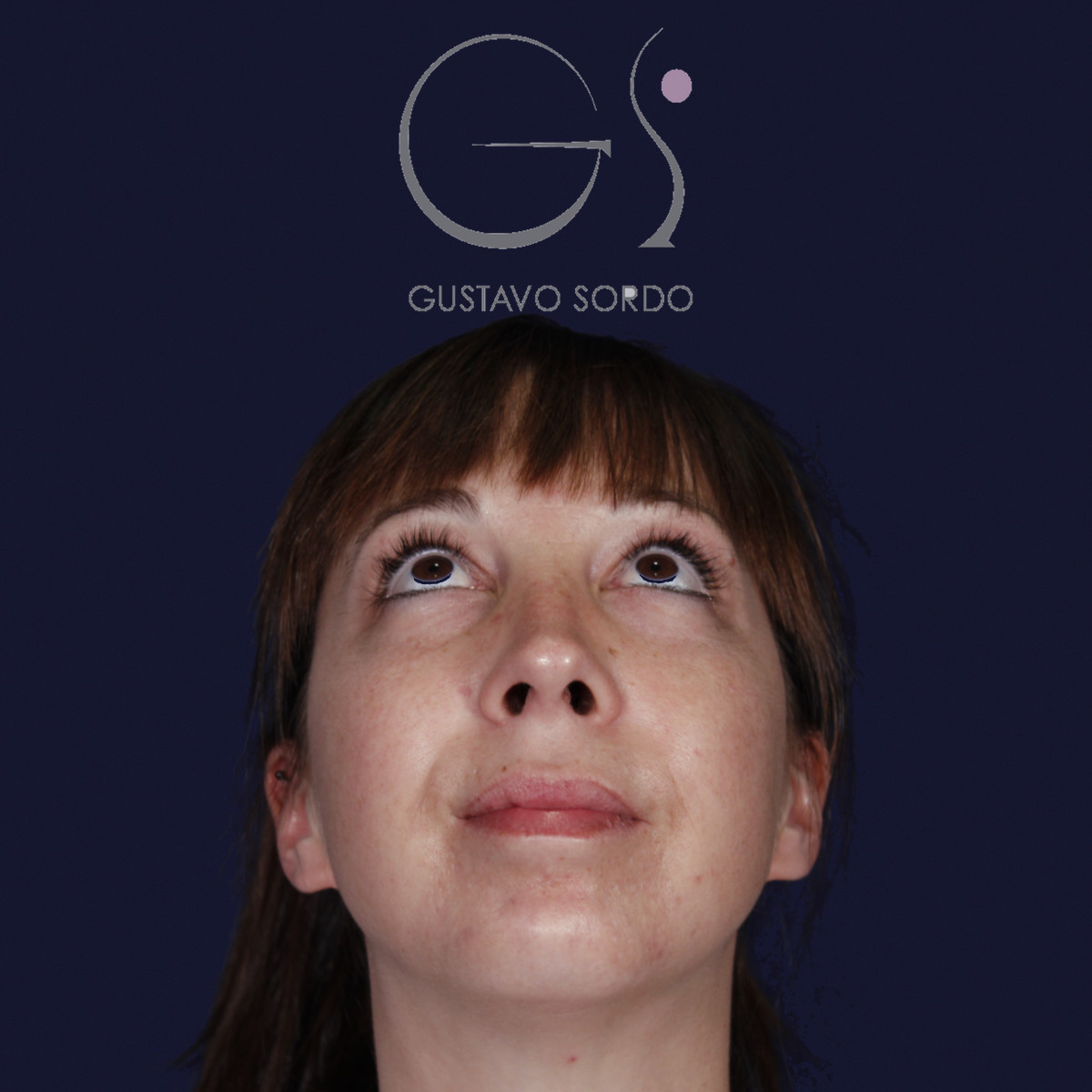 Rinoplastia ultrasónica y mentoplastia en nariz desviada, con el mentón elevado, al año de la mentoplastia — caso del Dr. Gustavo Sordo en Madrid