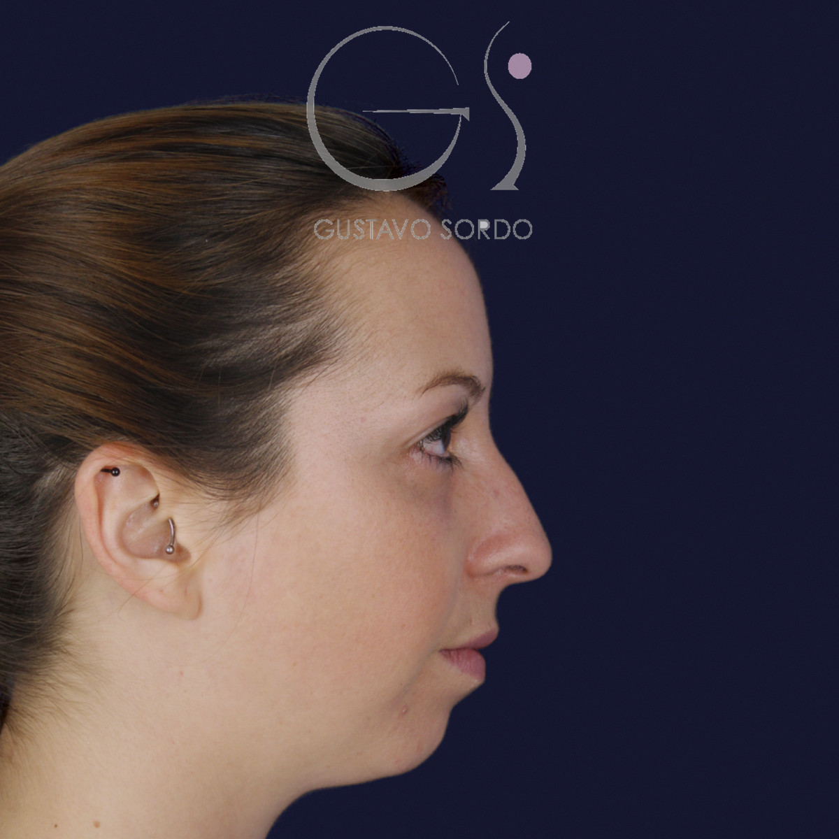 Rinoplastia ultrasónica y mentoplastia en nariz desviada, perfil derecho, antes de la cirugía — caso del Dr. Gustavo Sordo en Madrid