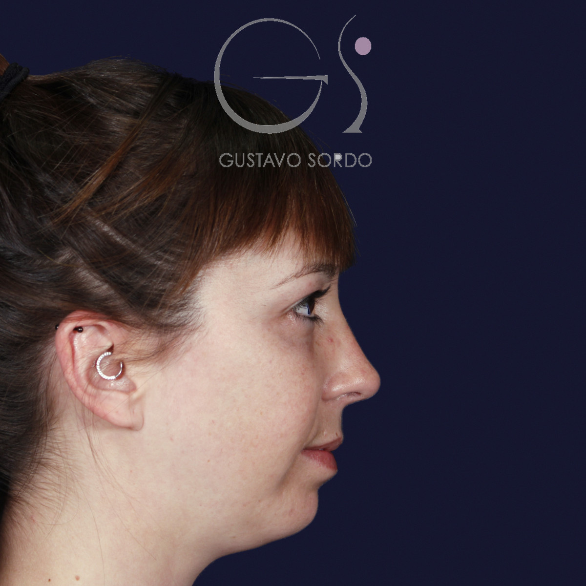 Rinoplastia ultrasónica y mentoplastia en nariz desviada, perfil derecho, al año de la mentoplastia — caso del Dr. Gustavo Sordo en Madrid
