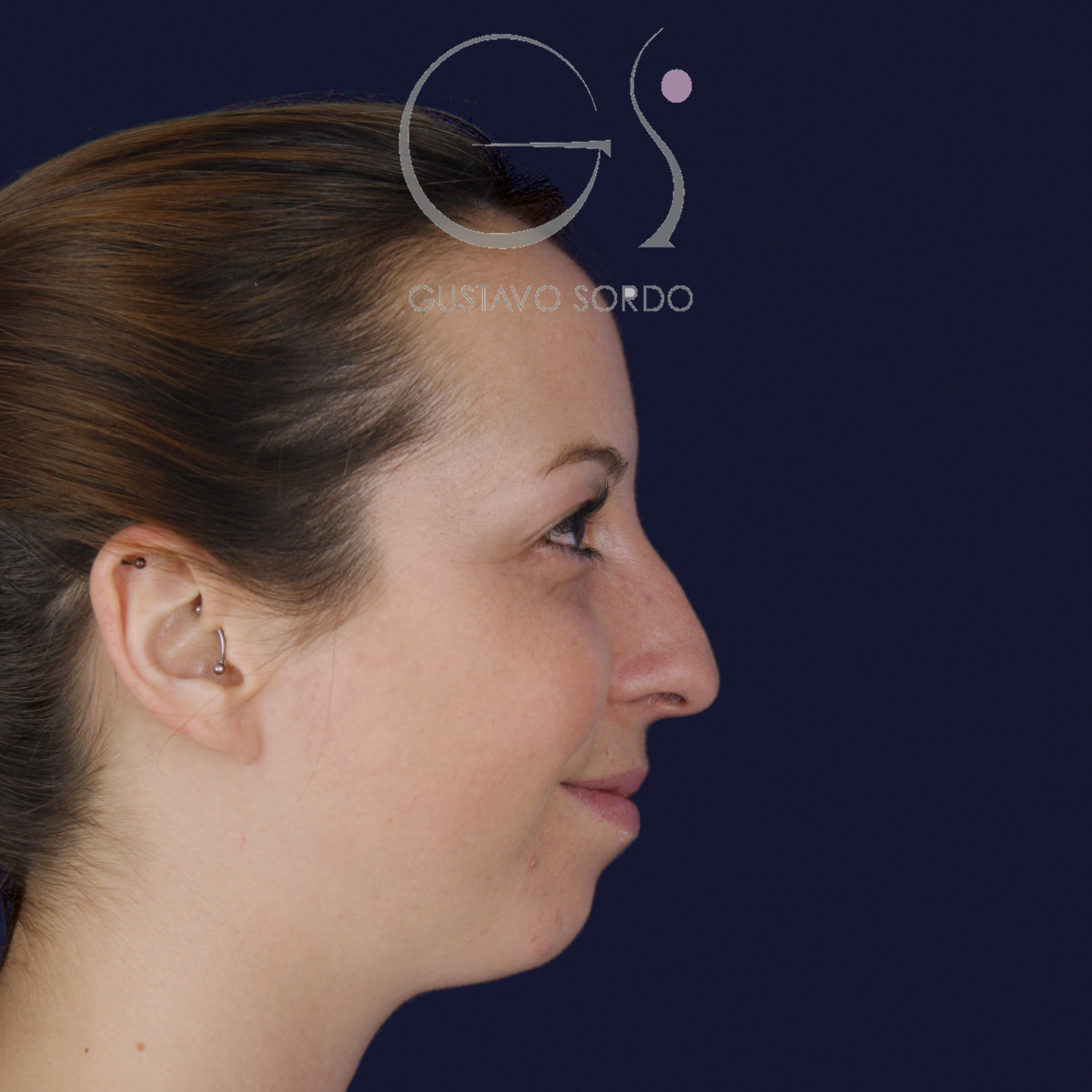 Rinoplastia ultrasónica y mentoplastia en nariz desviada, perfil derecho sonriendo, antes de la cirugía — caso del Dr. Gustavo Sordo en Madrid