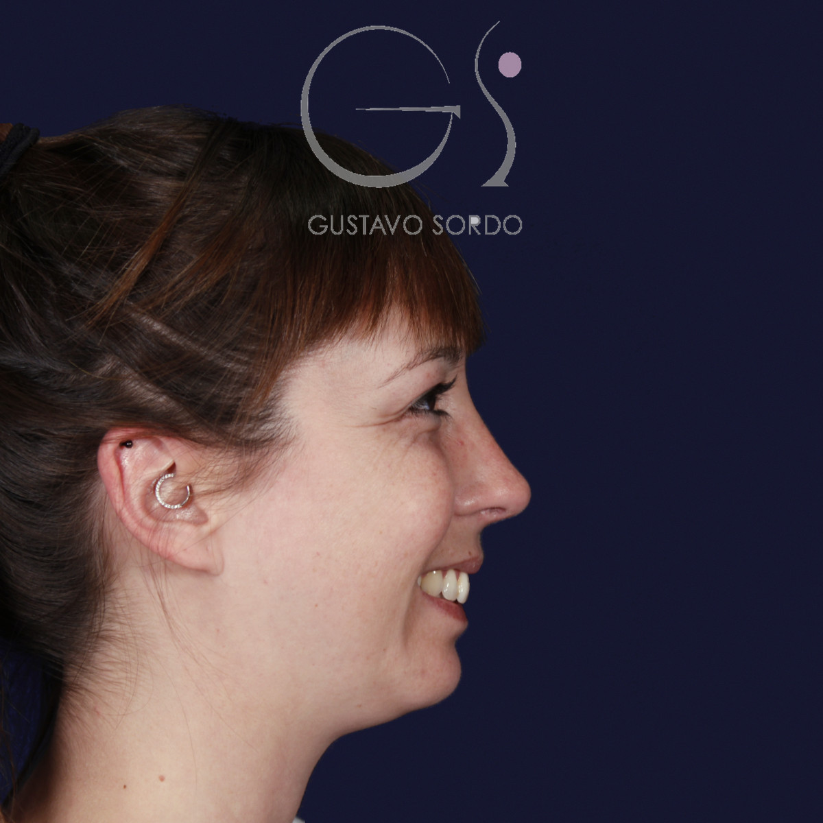 Rinoplastia ultrasónica y mentoplastia en nariz desviada, perfil derecho sonriendo, al año de la mentoplastia — caso del Dr. Gustavo Sordo en Madrid