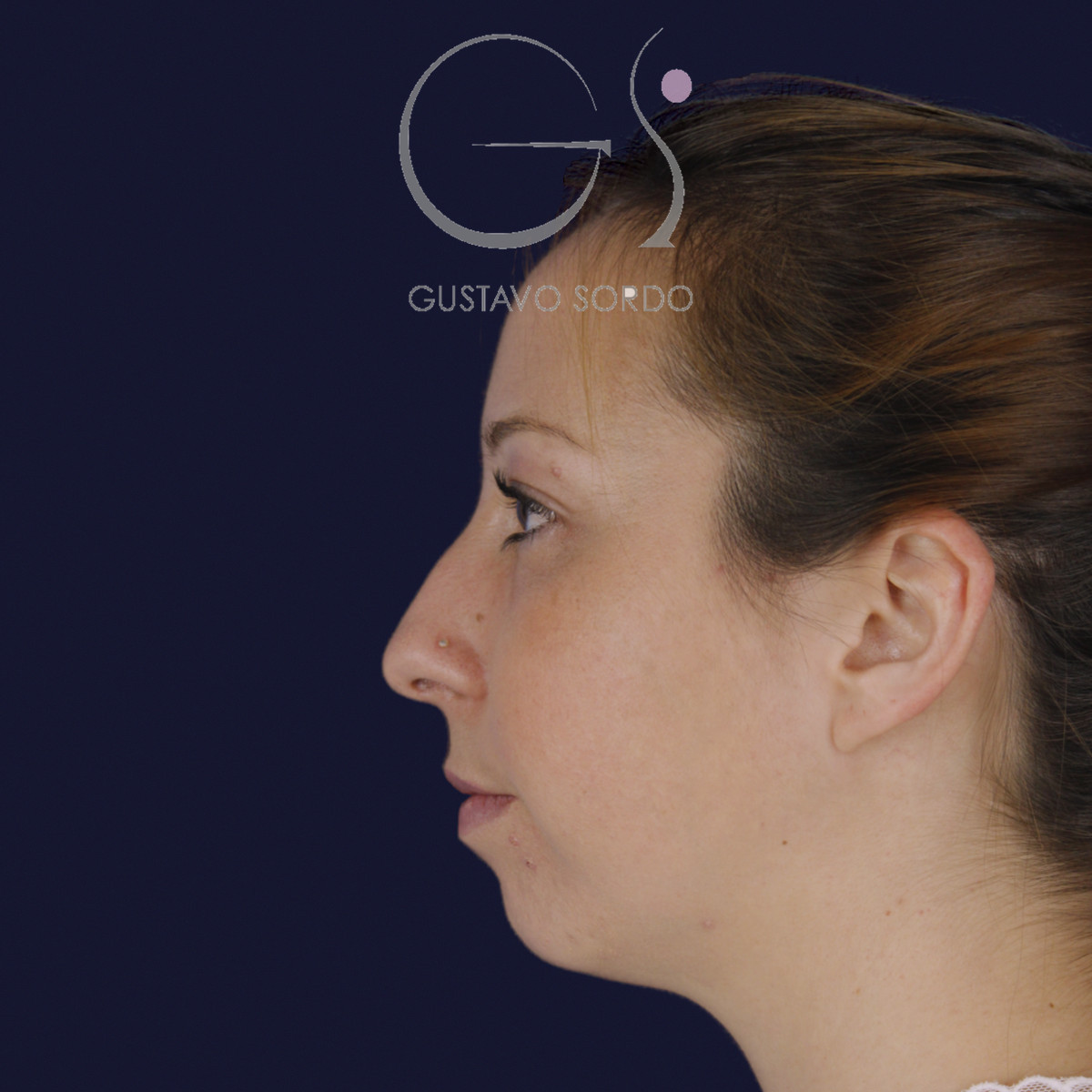 Rinoplastia ultrasónica y mentoplastia en nariz desviada, perfil izquierdo, antes de la cirugía — caso del Dr. Gustavo Sordo en Madrid