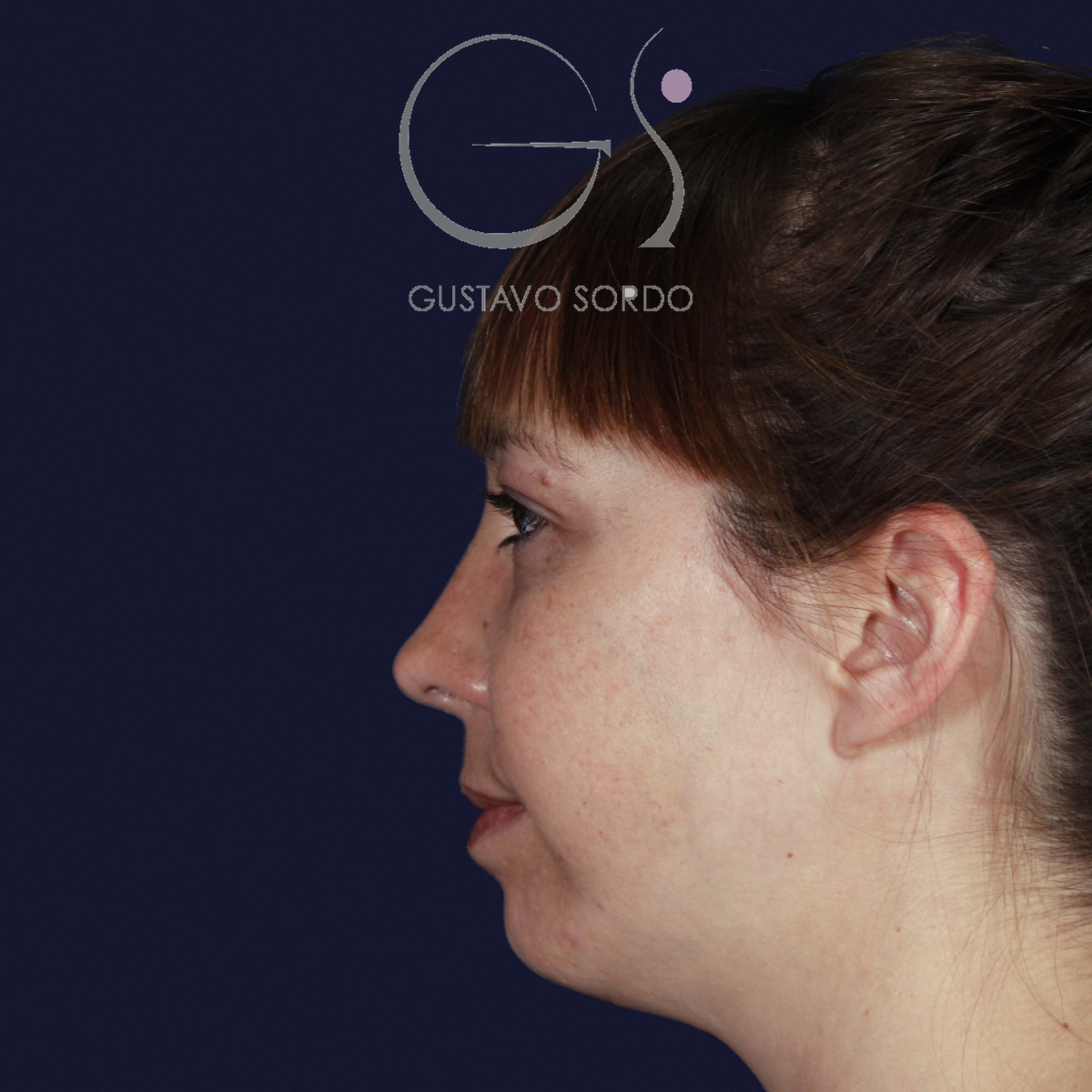 Rinoplastia ultrasónica y mentoplastia en nariz desviada, perfil izquierdo, al año de la mentoplastia — caso del Dr. Gustavo Sordo en Madrid