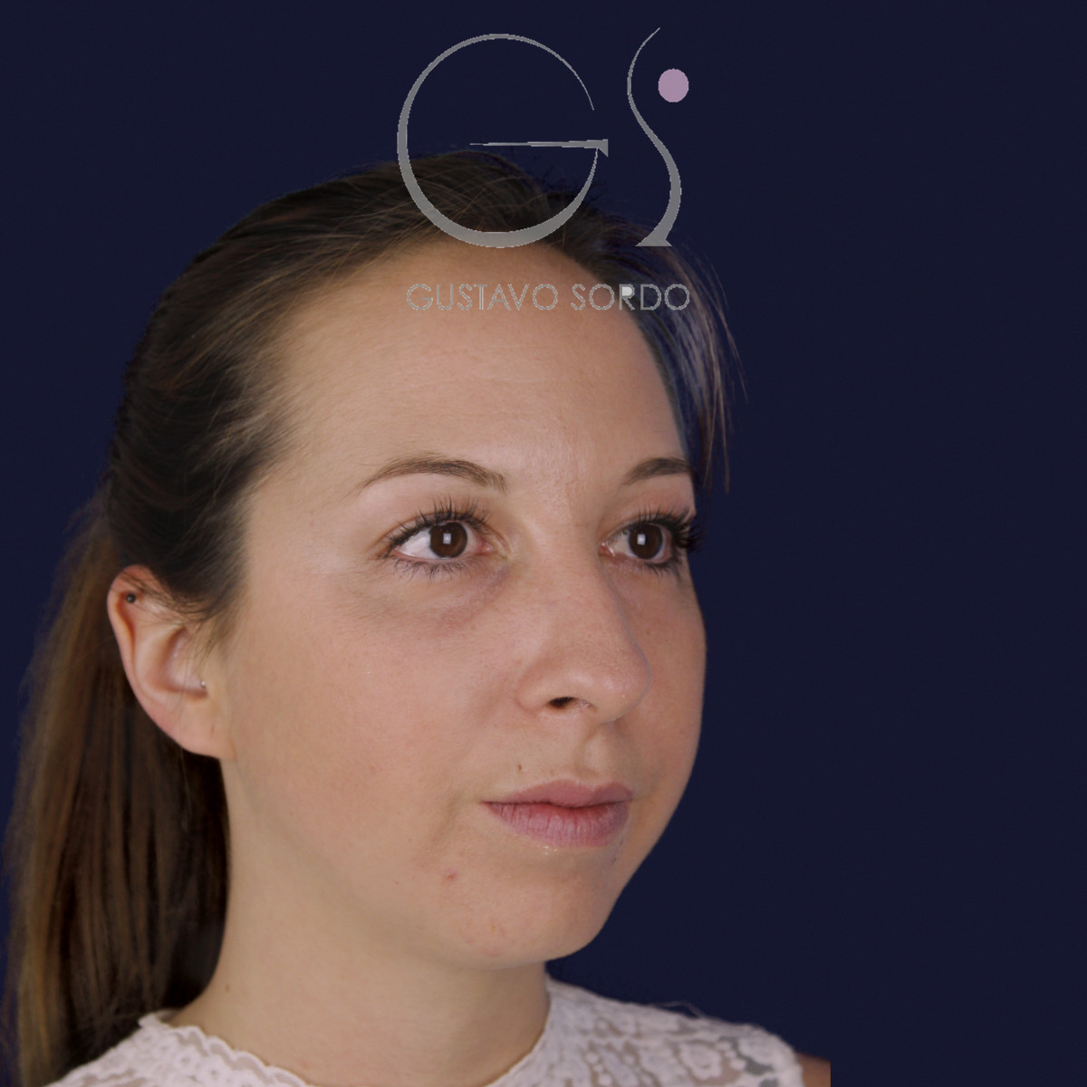 Rinoplastia ultrasónica y mentoplastia en nariz desviada, semiperfil derecho, antes de la cirugía — caso del Dr. Gustavo Sordo en Madrid