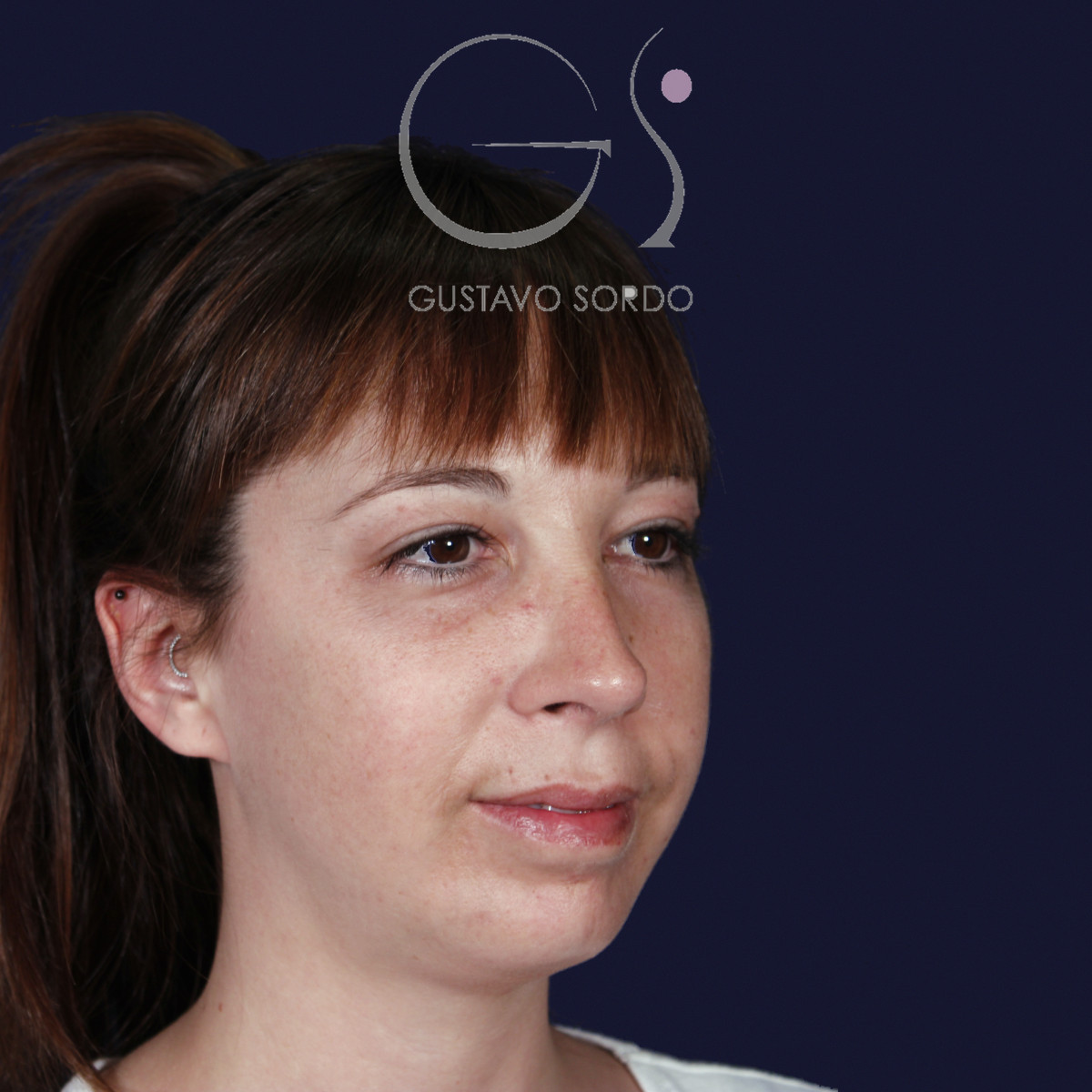 Rinoplastia ultrasónica y mentoplastia en nariz desviada, semiperfil derecho, al año de la mentoplastia — caso del Dr. Gustavo Sordo en Madrid