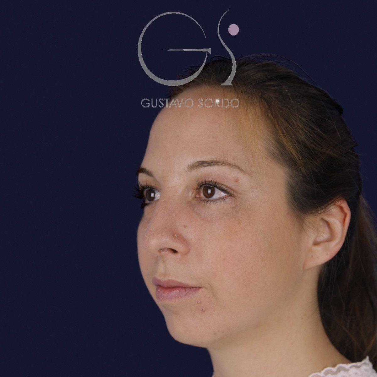 Rinoplastia ultrasónica y mentoplastia en nariz desviada, semiperfil izquierdo, antes de la cirugía — caso del Dr. Gustavo Sordo en Madrid