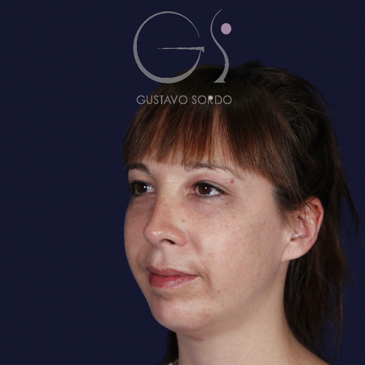 Rinoplastia ultrasónica y mentoplastia en nariz desviada, semiperfil izquierdo, al año de la mentoplastia — caso del Dr. Gustavo Sordo en Madrid