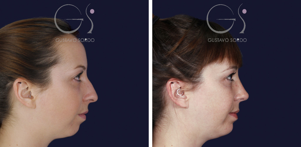 Rinoplastia ultrasónica y mentoplastia en nariz desviada: perfil derecho antes y después — caso del Dr. Gustavo Sordo en Madrid