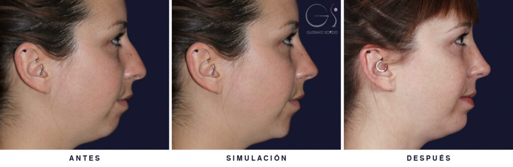 Rinoplastia y mentoplastia de perfil: antes, simulación y resultado de la misma paciente, operada por el Dr. Gustavo Sordo en Madrid