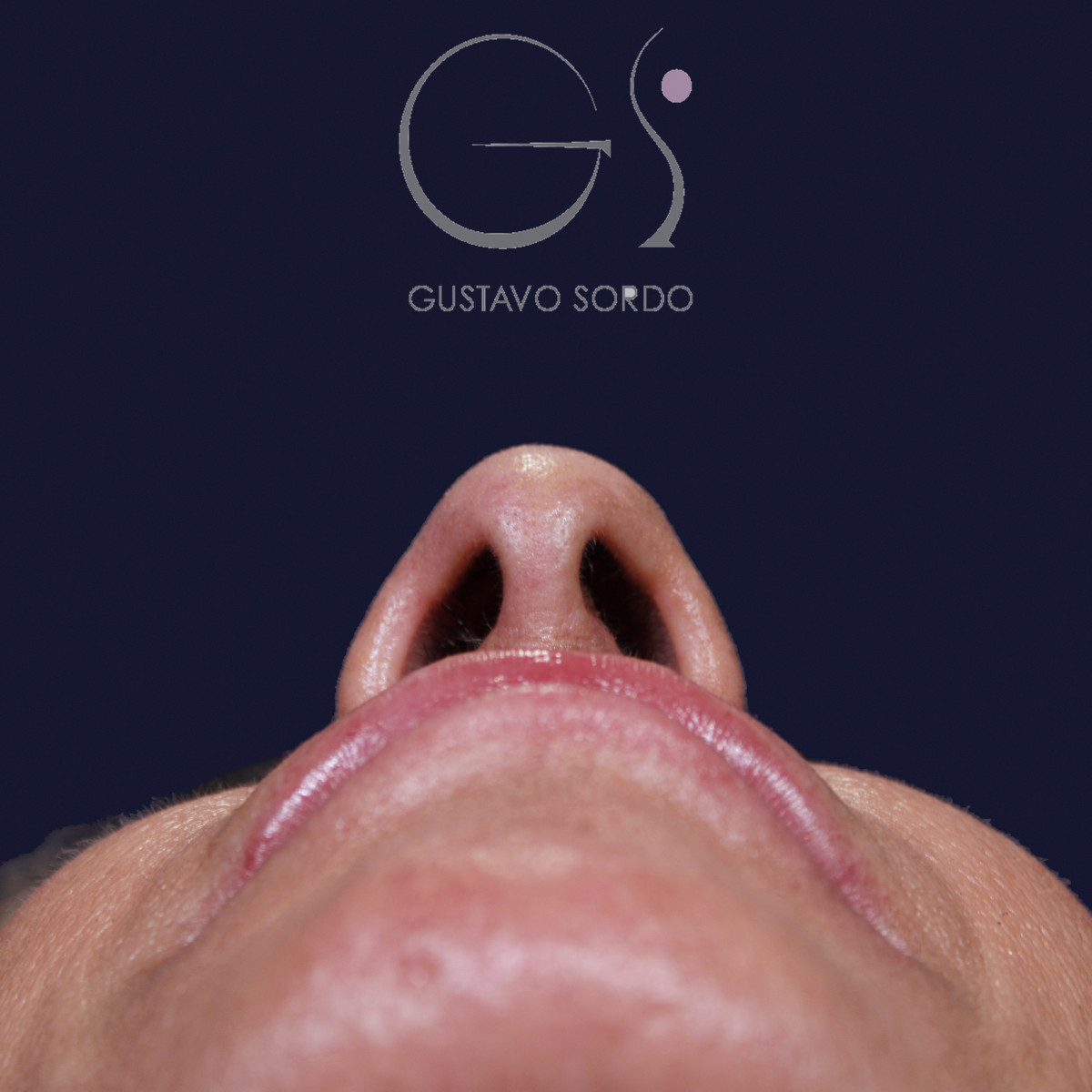 Antes de rinoplastia con mentoplastia en punta caída, vista basal