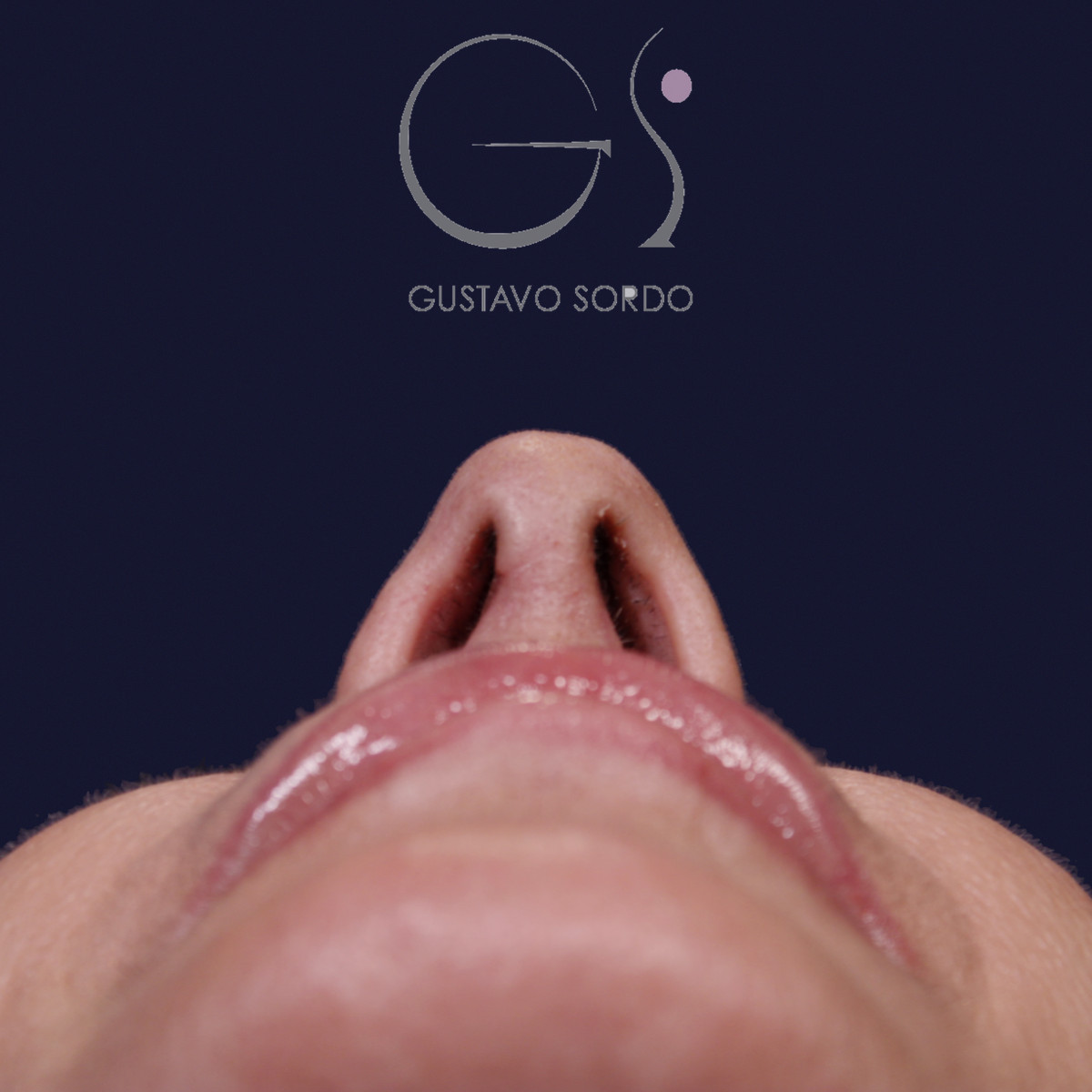Después de rinoplastia con mentoplastia en punta caída, al año, vista basal