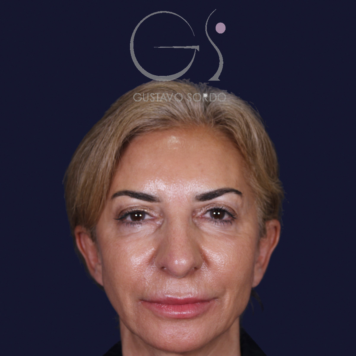 Antes de rinoplastia con mentoplastia en punta caída, vista frontal