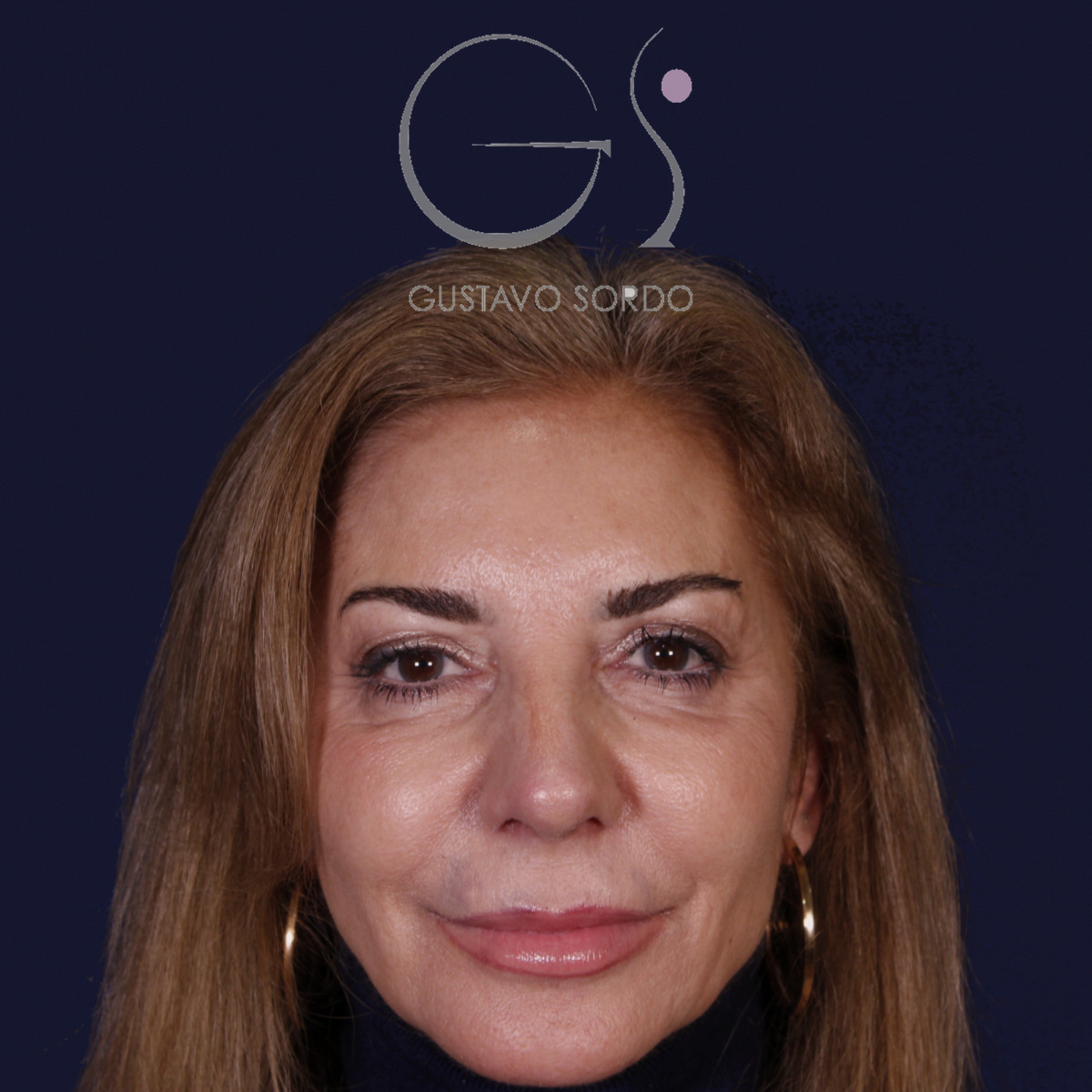 Después de rinoplastia con mentoplastia en punta caída, al año, vista frontal