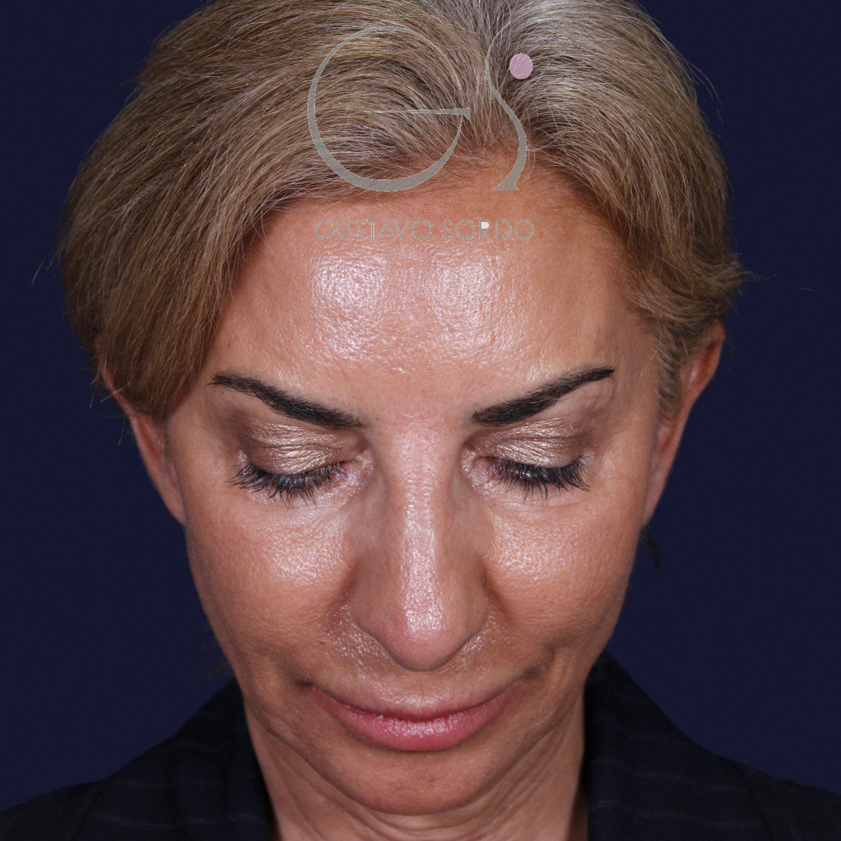 Antes de rinoplastia con mentoplastia en punta caída, vista frontal con el mentón abajo