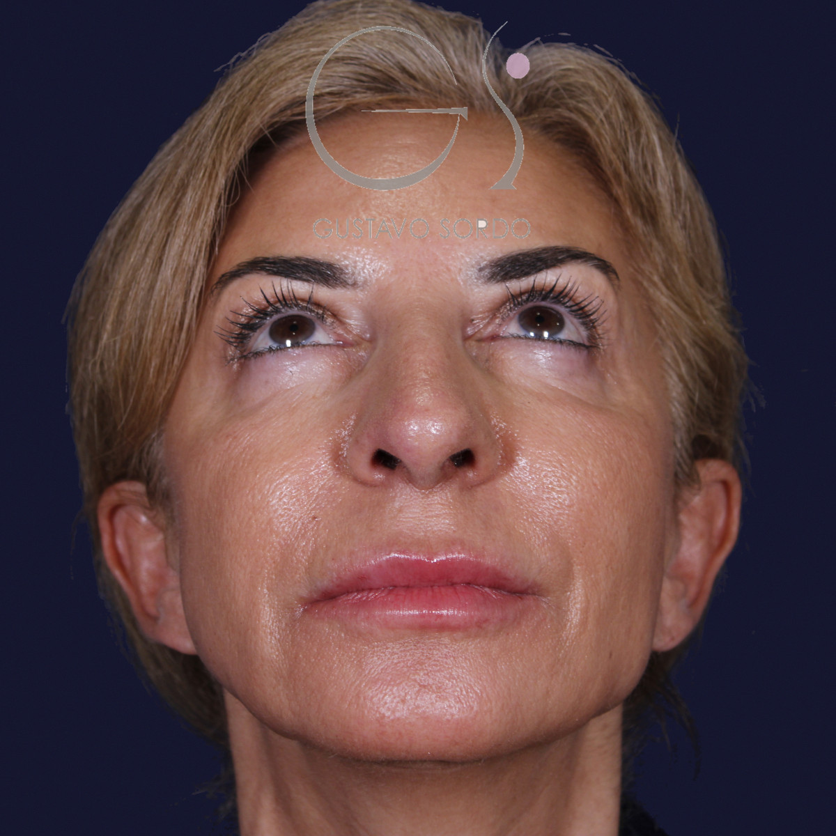 Antes de rinoplastia con mentoplastia en punta caída, vista frontal con el mentón arriba