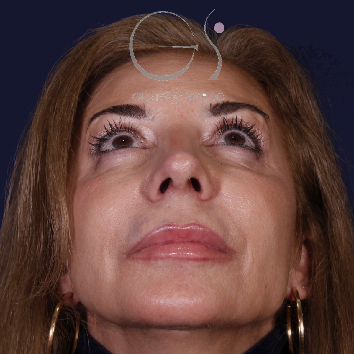 Después de rinoplastia con mentoplastia en punta caída, al año, vista frontal con el mentón arriba