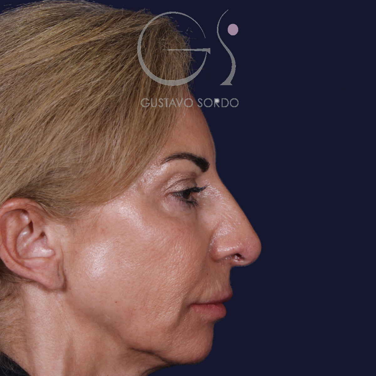 Antes de rinoplastia con mentoplastia en punta caída, vista de perfil derecho