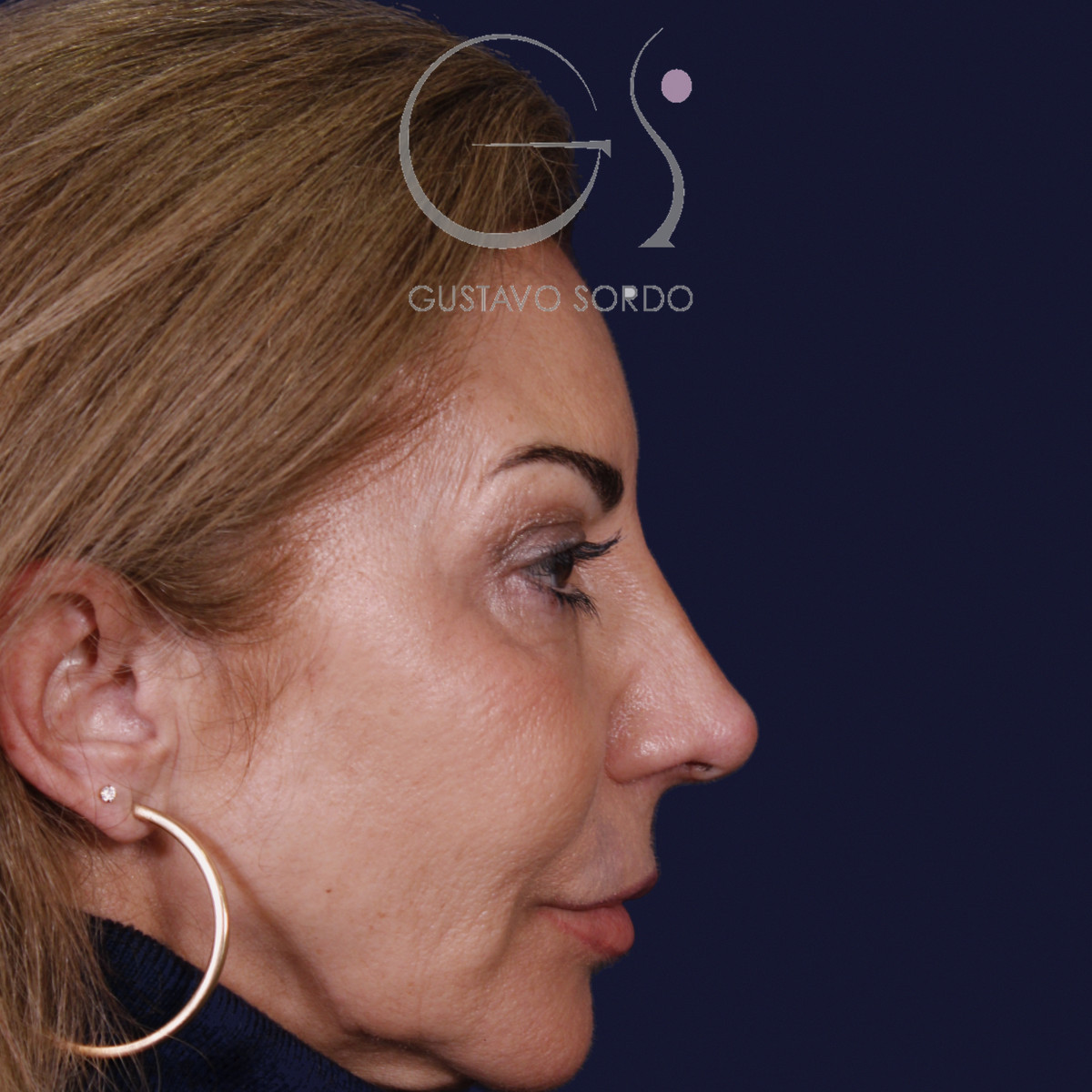 Rinoplastia con mentoplastia: perfil derecho al año — caso operado por el Dr. Gustavo Sordo en Madrid