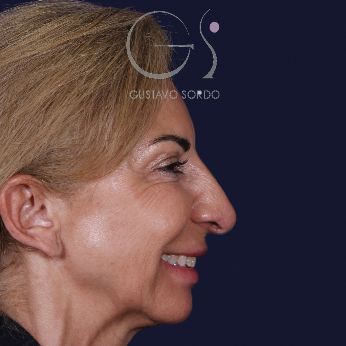Antes de rinoplastia con mentoplastia en punta caída, vista de perfil derecho sonriendo