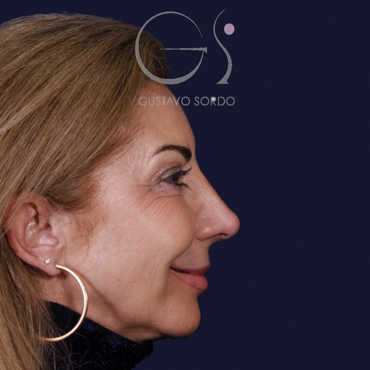 Después de rinoplastia con mentoplastia en punta caída, al año, vista de perfil derecho sonriendo