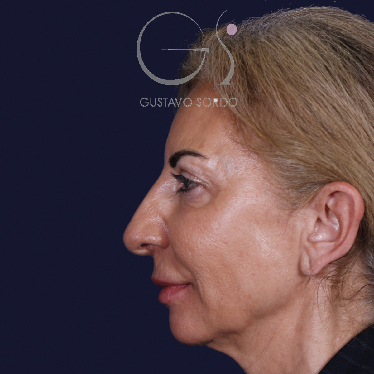 Antes de rinoplastia con mentoplastia en punta caída, vista de perfil izquierdo