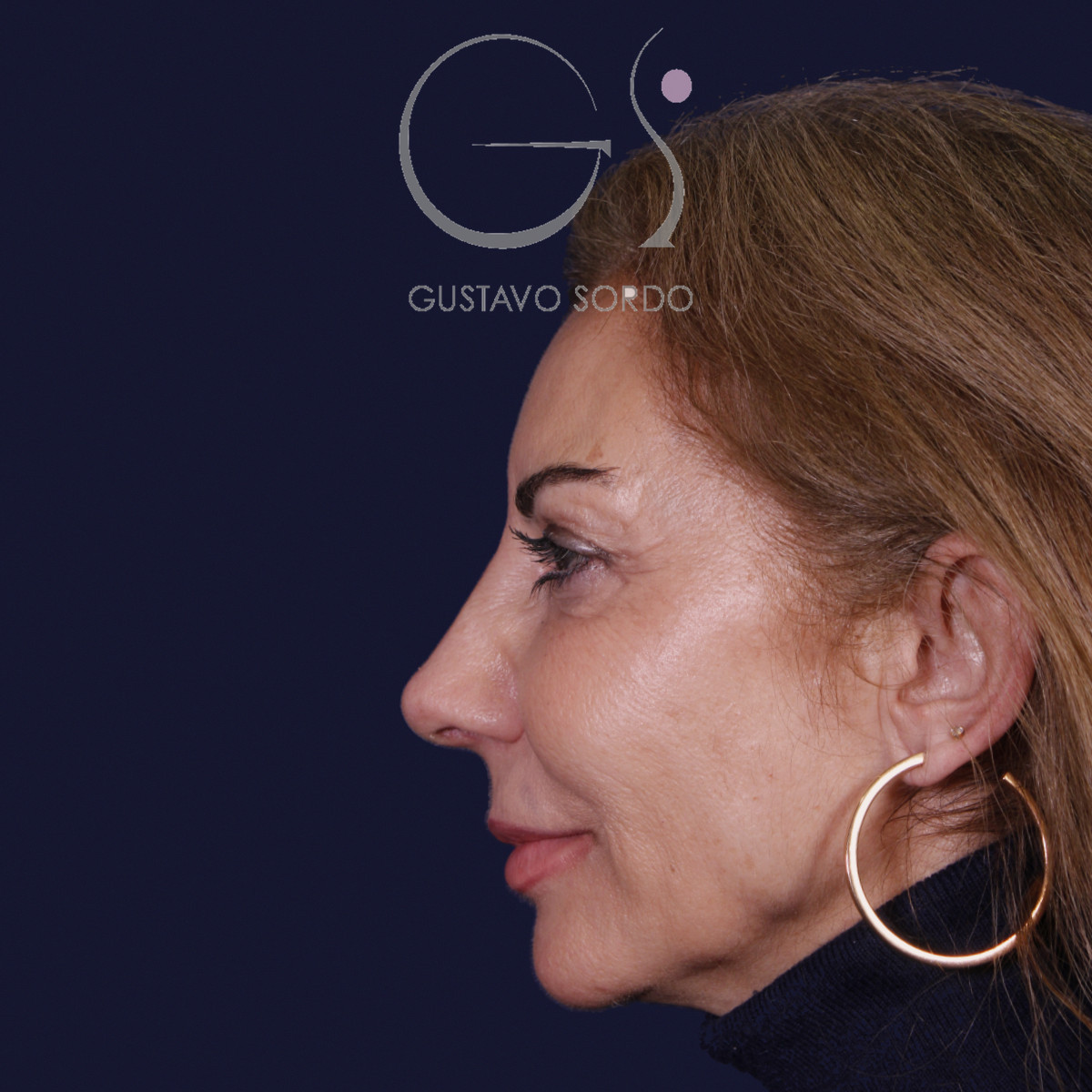 Después de rinoplastia con mentoplastia en punta caída, al año, vista de perfil izquierdo