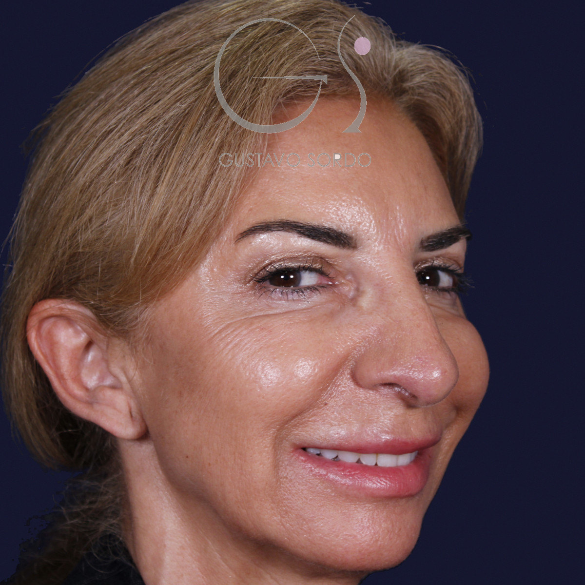 Antes de rinoplastia con mentoplastia en punta caída, vista de semiperfil derecho
