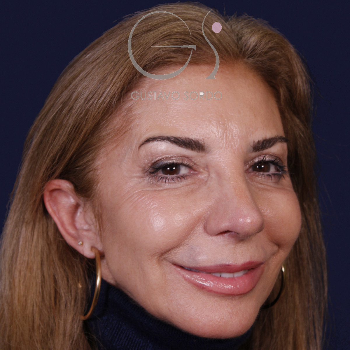 Después de rinoplastia con mentoplastia en punta caída, al año, vista de semiperfil derecho