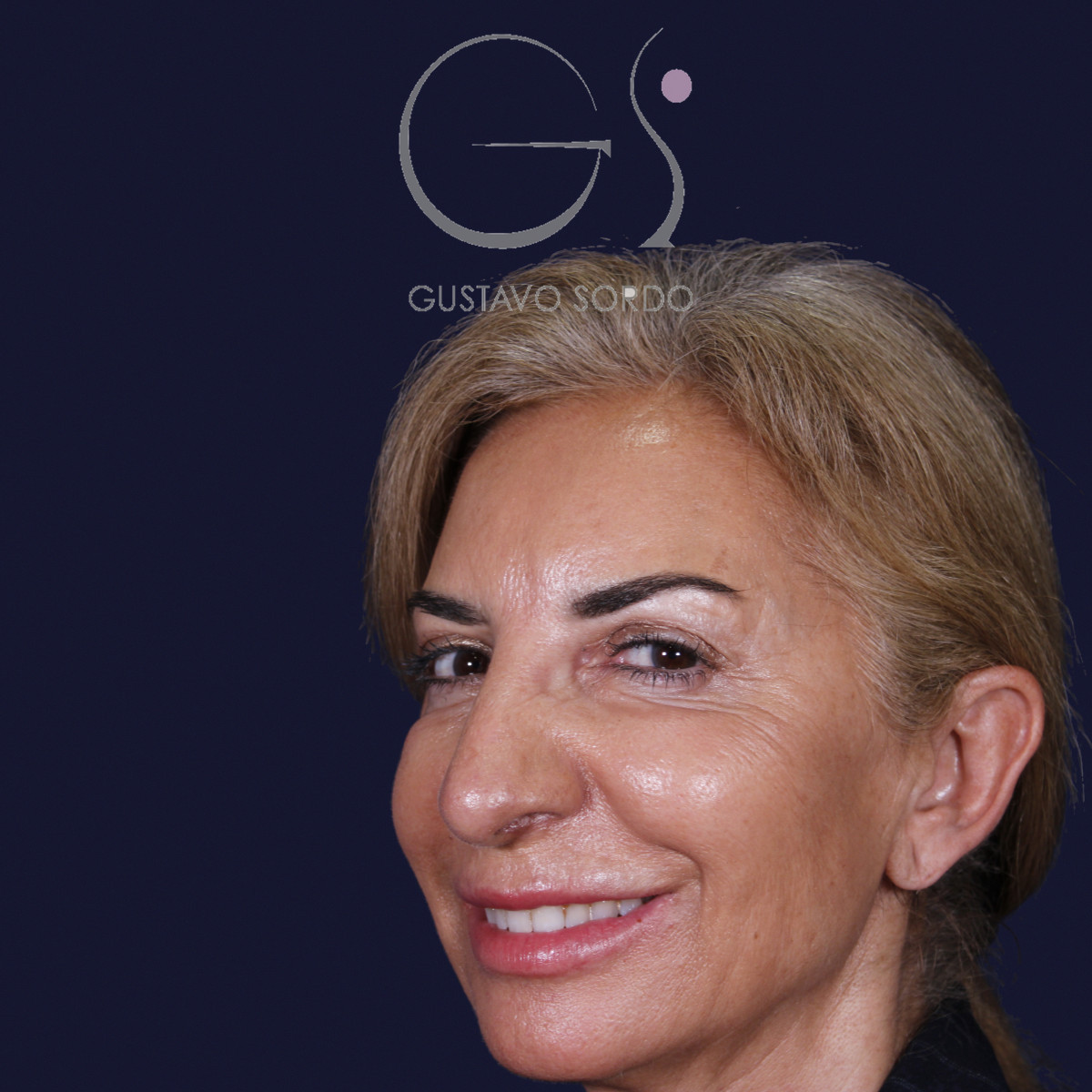 Antes de rinoplastia con mentoplastia en punta caída, vista de semiperfil izquierdo