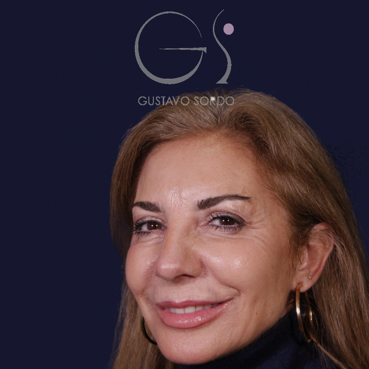 Después de rinoplastia con mentoplastia en punta caída, al año, vista de semiperfil izquierdo