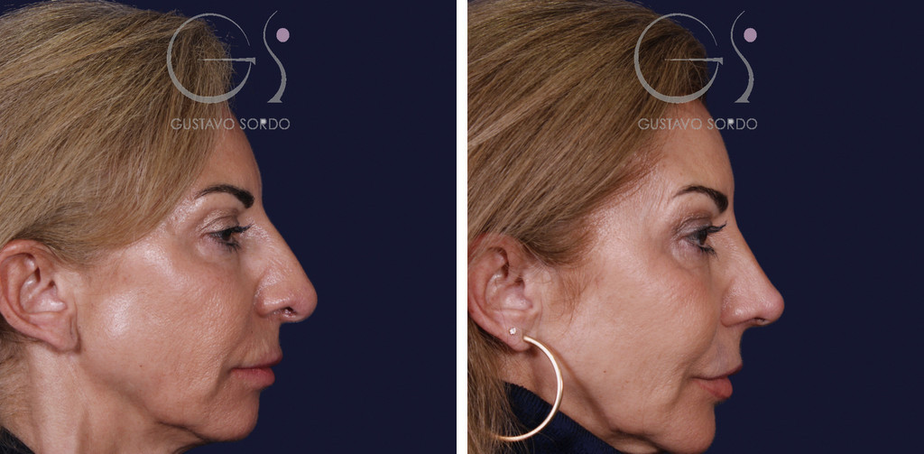Rinoplastia con mentoplastia y punta caída: antes y al año, perfil derecho