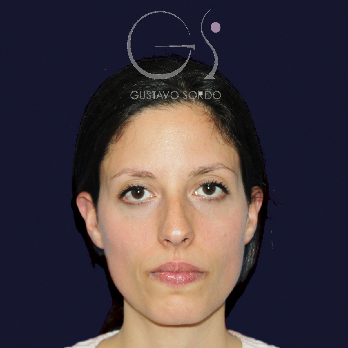 Antes de rinoplastia en nariz a tensión, vista frontal