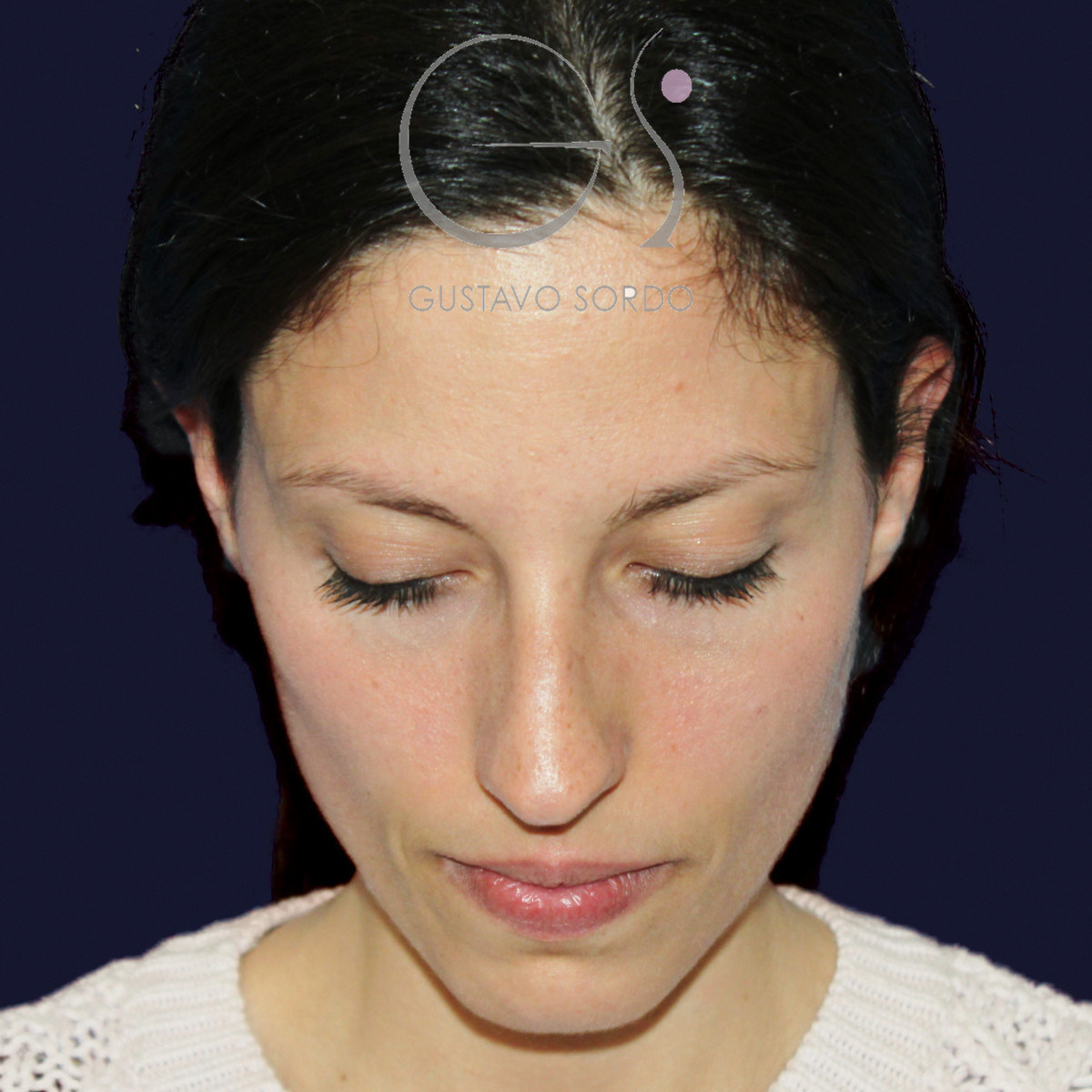 Antes de rinoplastia en nariz a tensión, vista frontal con el mentón abajo