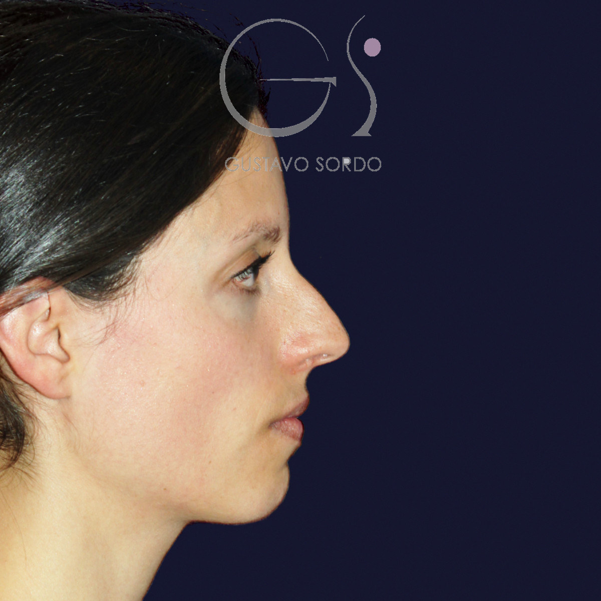 Antes de rinoplastia en nariz a tensión, vista de perfil derecho