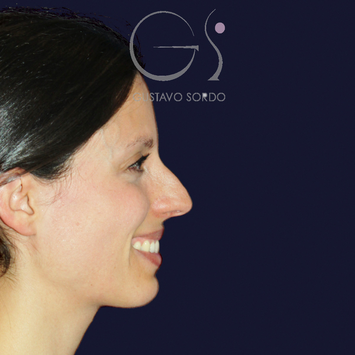 Antes de rinoplastia en nariz a tensión, vista de perfil derecho sonriendo
