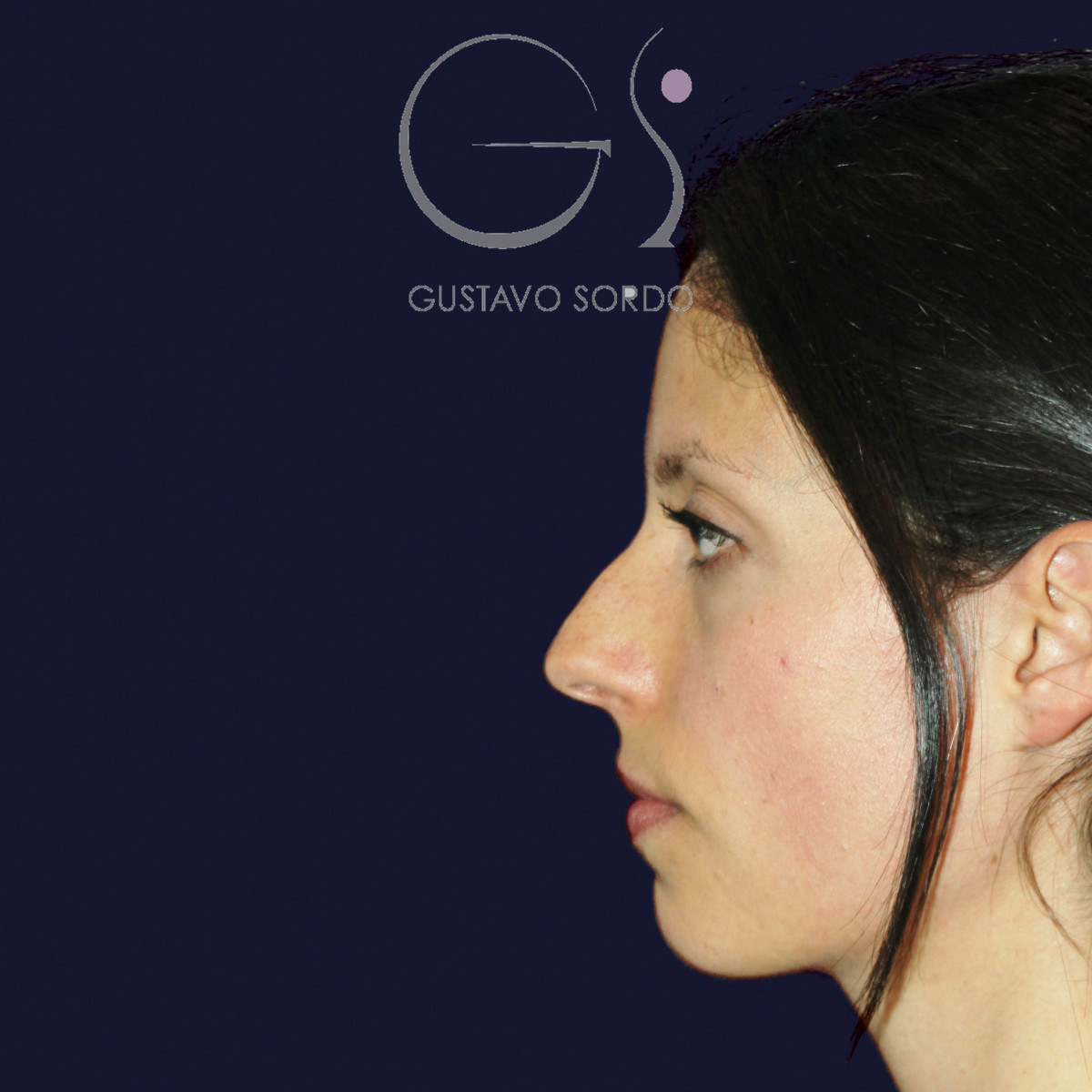 Antes de rinoplastia en nariz a tensión, vista de perfil izquierdo