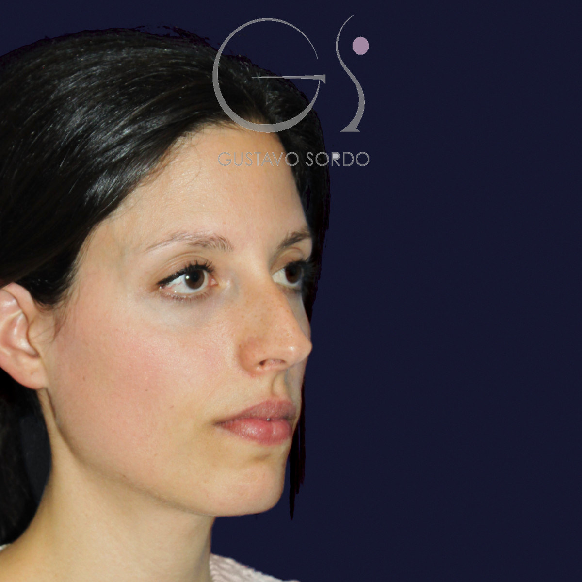 Antes de rinoplastia en nariz a tensión, vista de semiperfil derecho