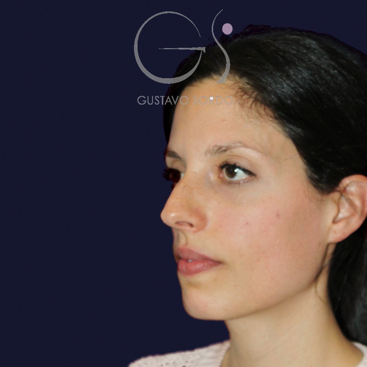 Antes de rinoplastia en nariz a tensión, vista de semiperfil izquierdo