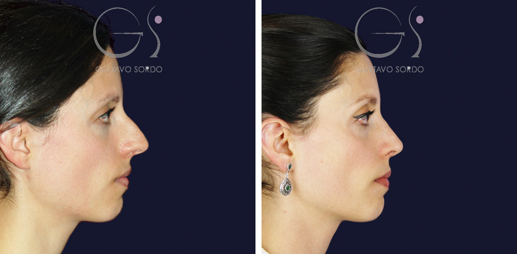 Rinoplastia en nariz a tensión: antes y al año, perfil derecho