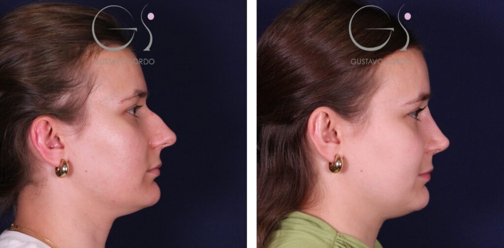 Rinoplastia en nariz aguileña con giba y punta caída: antes y después de un caso operado en Madrid