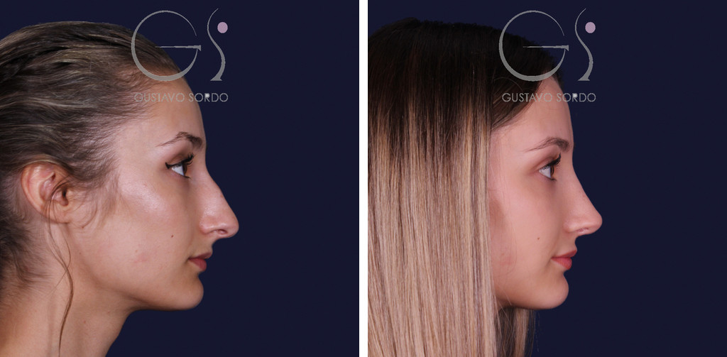 Rinoplastia en nariz aguileña y proyectada: antes y al año, perfil derecho