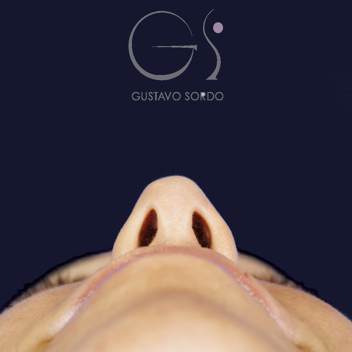Después de rinoplastia en nariz ancha con dorso en V, a los 15 meses, vista basal