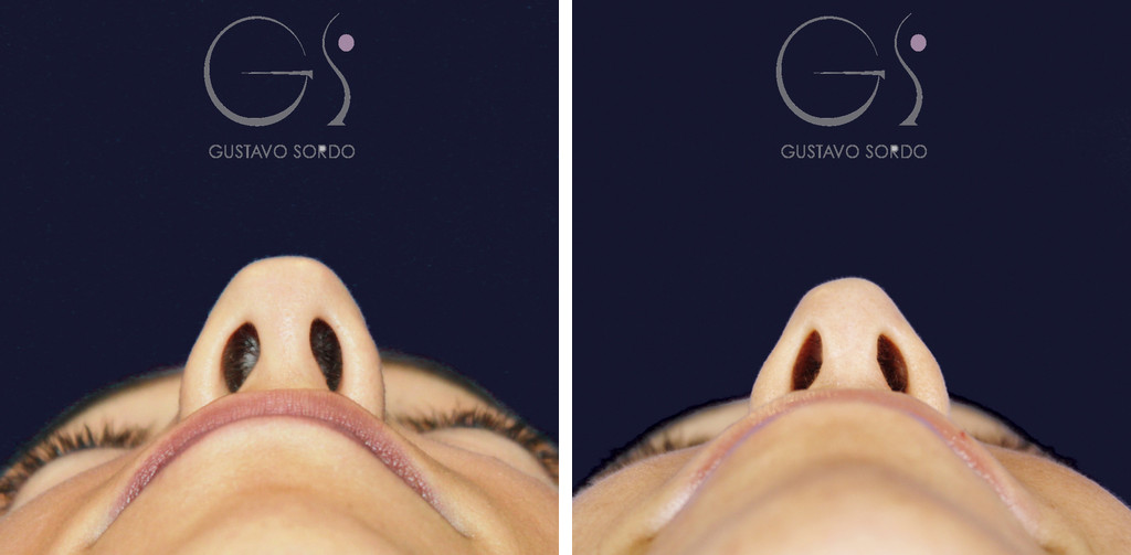 Rhinoplastik mit Allotomie: Nasenbasis vor und nach 15 Monaten, Basalansicht