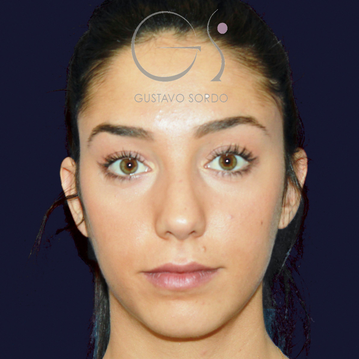 Antes de rinoplastia en nariz ancha con dorso en V, vista frontal