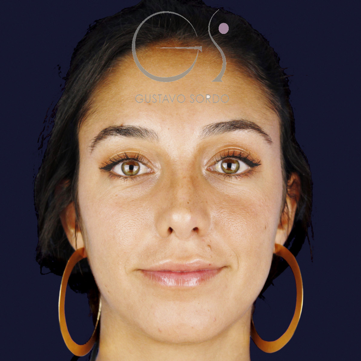 Después de rinoplastia en nariz ancha con dorso en V, a los 15 meses, vista frontal
